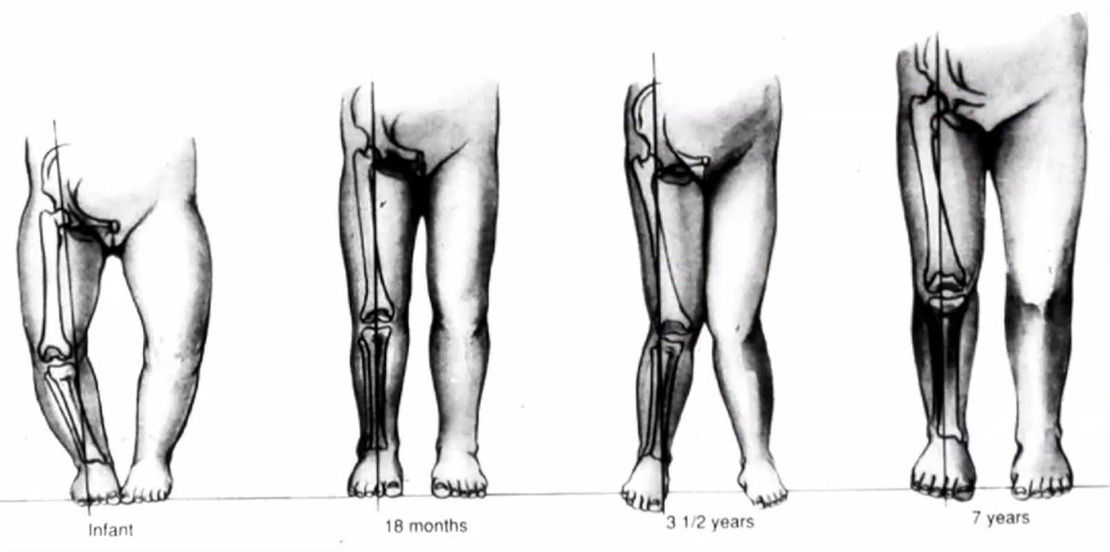 Ilustración sobre desarrollo normal musculoesquelético en niños.