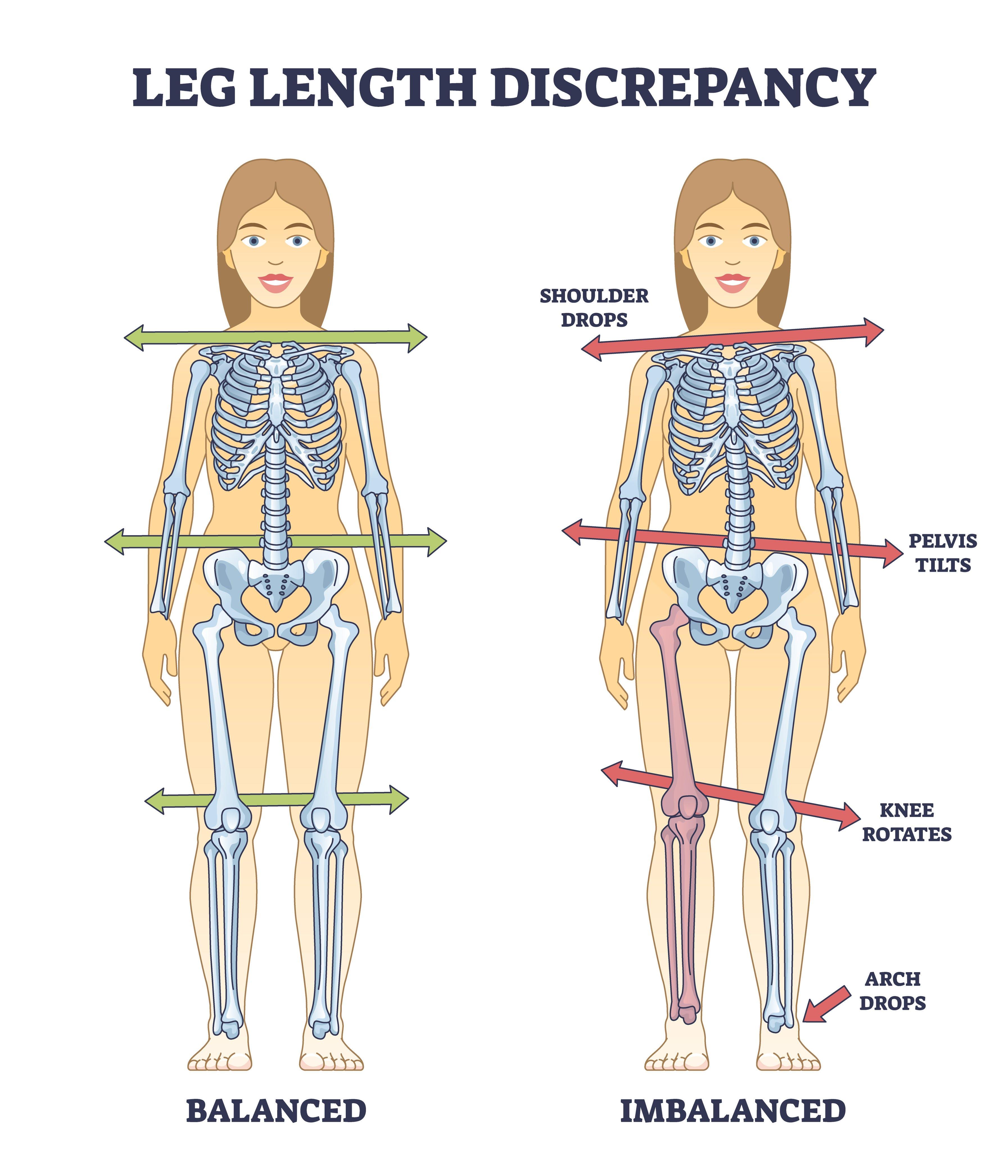 Comparación de discrepancia de longitud en adultos.