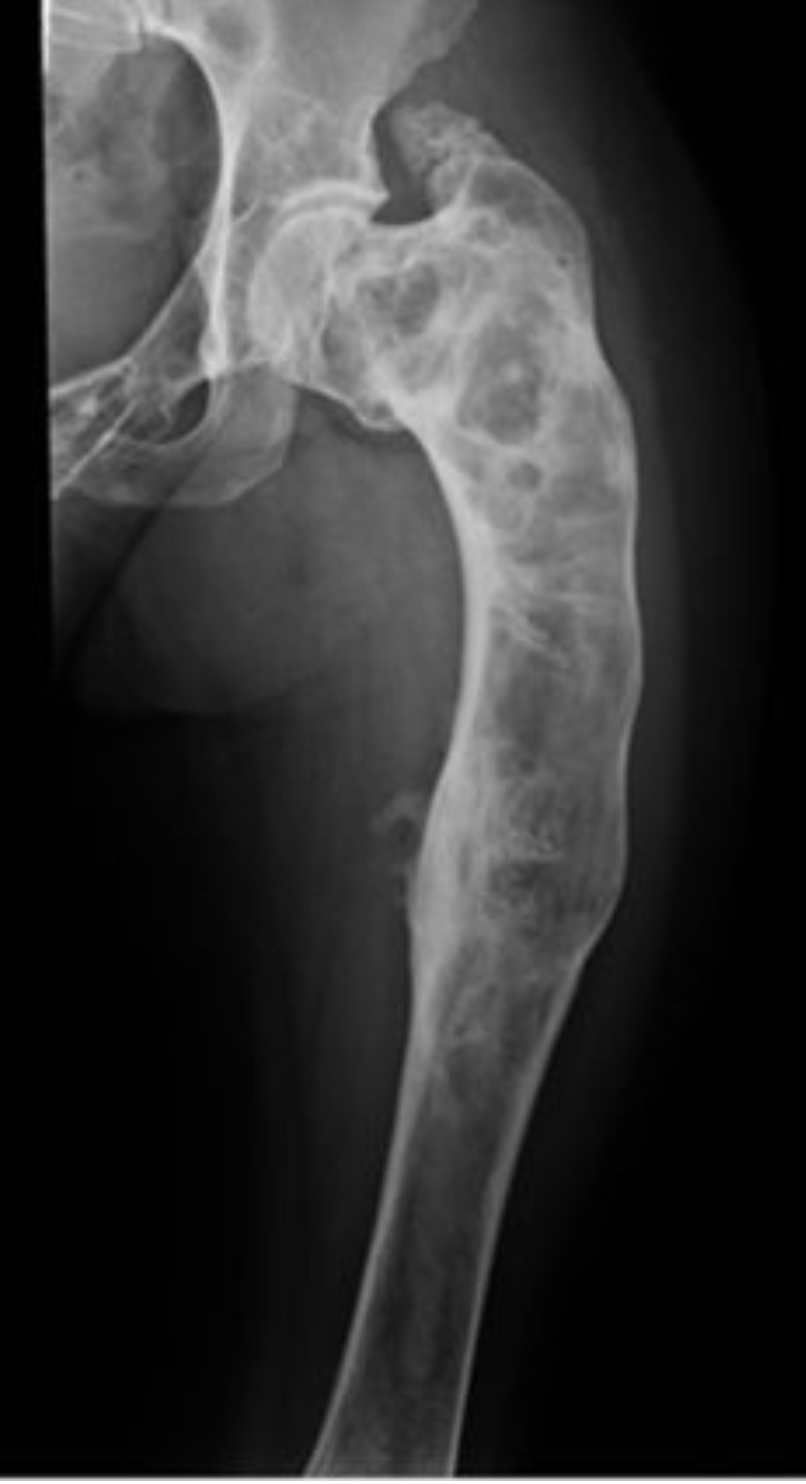 Ilustración o imagen clínica de displasia fibrosa.