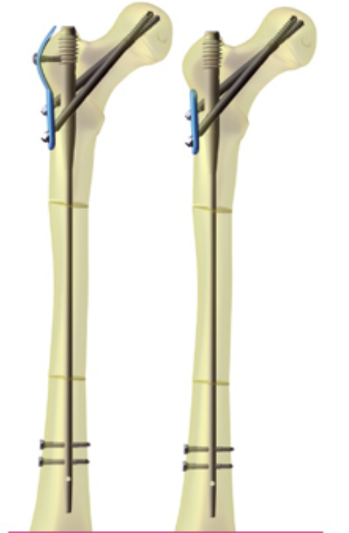 Imagen relacionada con dispositivos avanzados para la protección de huesos frágiles en osteogénesis imperfecta.