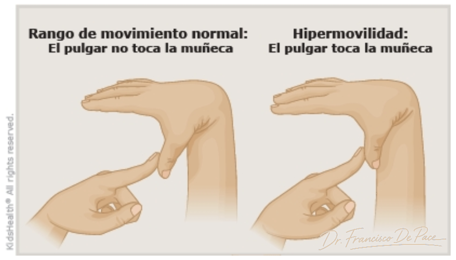 Ilustración de hiperelasticidad benigna en niños.