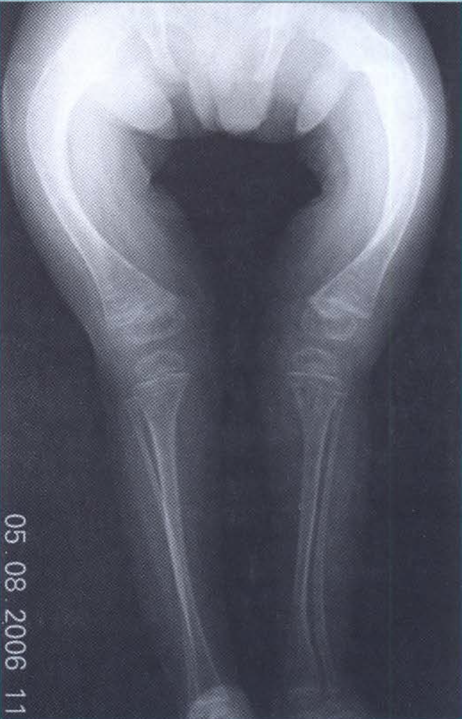 Radiografía de osteogénesis imperfecta con deformidad de ambos fémures.
