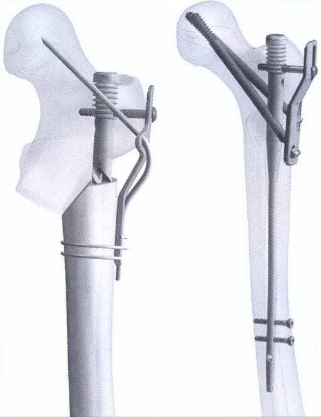 Ilustración de corrección quirúrgica proximal femoral en osteogénesis imperfecta.