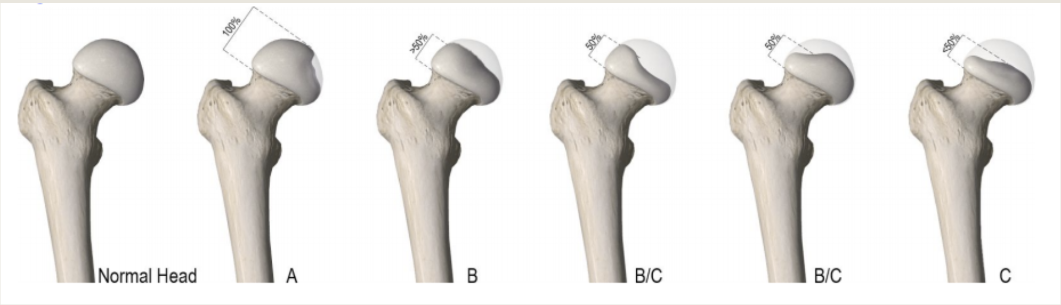 Esquema de clasificación radiográfica del pilar lateral en enfermedad de Perthes.