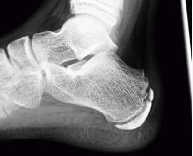 Radiografía lateral de un talón infantil en crecimiento que muestra la apófisis posterior del calcáneo.