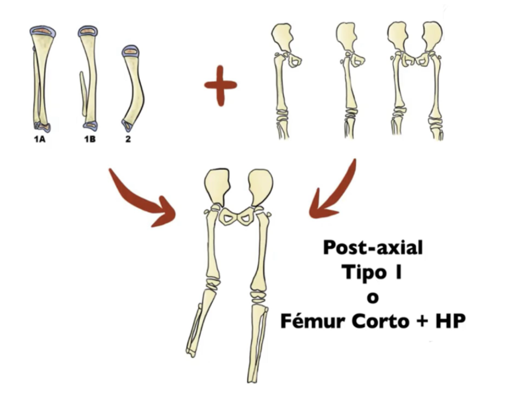 Esquema del síndrome hipoplásico de los miembros inferiores con patrón postaxial, fémur corto e hipoplasia peroneal.